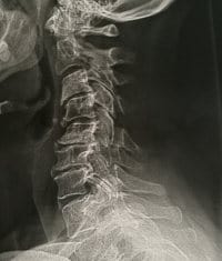 Arthrose cervicale - Cervicalgie - Torti coli